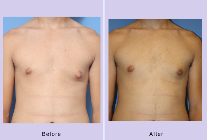 Before and After Image: Gynecomastia Reduction – Case 3 - front