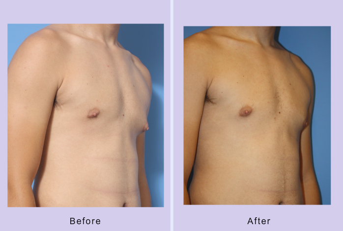 Before and After Image: Gynecomastia Reduction – Case 3 - right-front-oblique