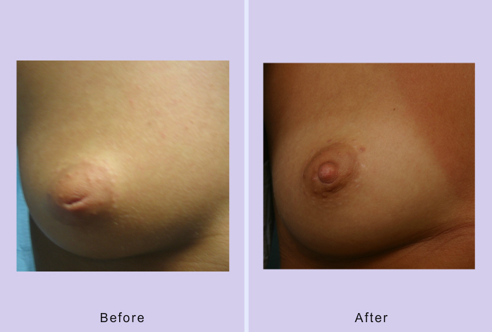 Before and After Image: Inverted nipple repair – case 2 - front