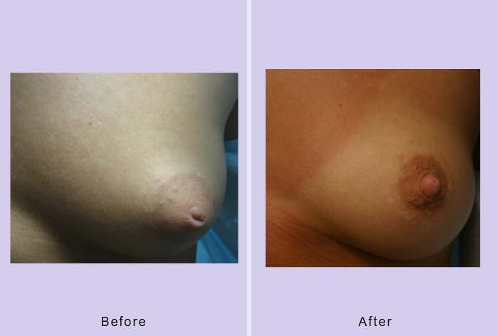 Before and After Image: Inverted nipple repair – case 3 - front