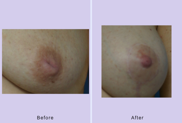 Before and After Image: Inverted nipple repair – case 4 - front