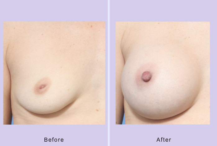 Before and After Image: Inverted nipple repair – case 5 - front