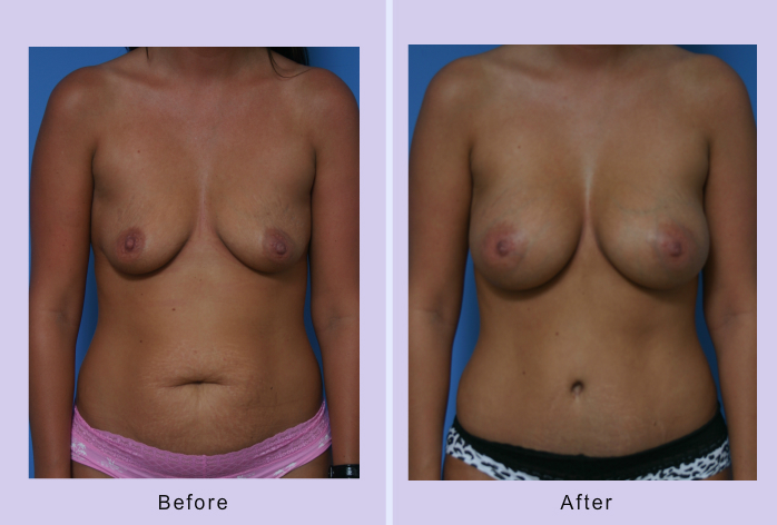 Before and After Image: Mommy makeover – Case 4 - front