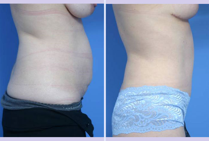 Before and After Image: abdominoplasty – tummy tuck – Case 1 - right-side