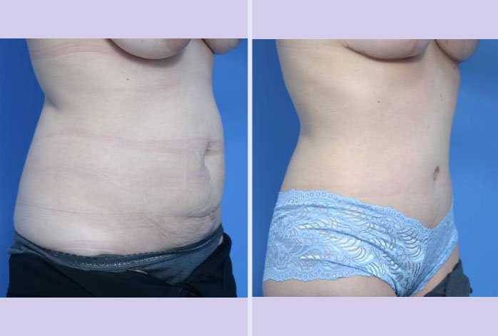 Before and After Image: abdominoplasty – tummy tuck – Case 1 - right-front-oblique