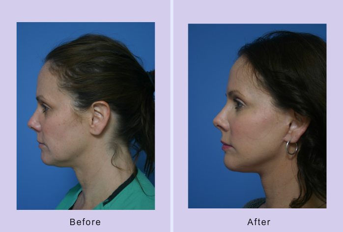 Before and After Image: 3-d volumetric facelift – case 12 - other