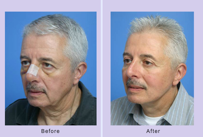 Before and After Image: 3-D volumetric facelift – case 14 - other