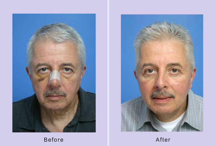 Before and After Image: 3-D volumetric facelift – case 14 - front