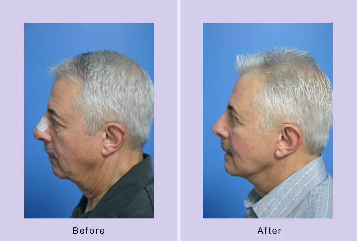 Before and After Image: 3-D volumetric facelift – case 14 - left-side