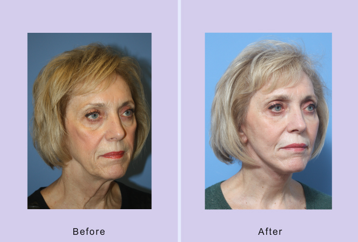Before and After Image: 3-d volumetric facelift – case 15 - right-front-oblique