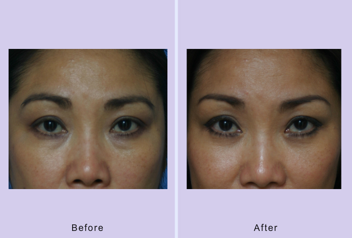 Before and After Image: Blepharoplasty – case 15 - front