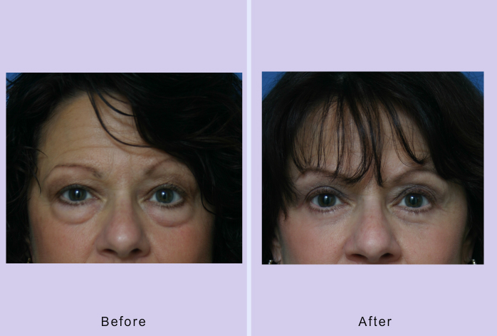 Before and After Image: Blepharoplasty – Case 16 - front