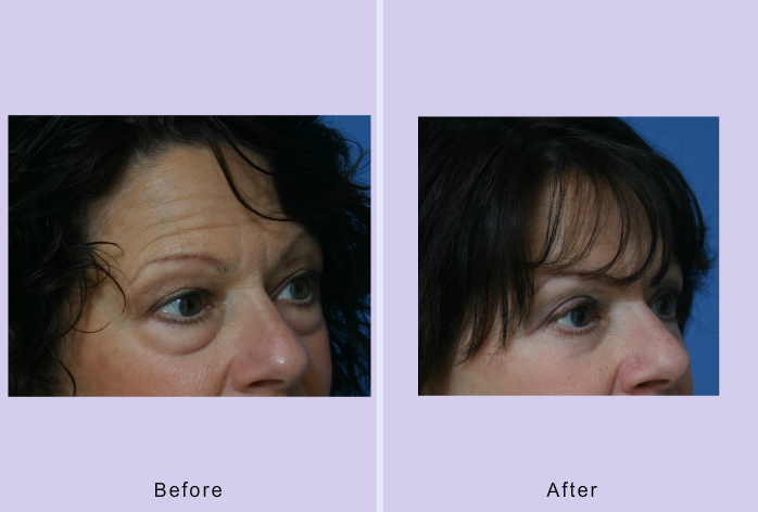 Before and After Image: Blepharoplasty – Case 16 - other