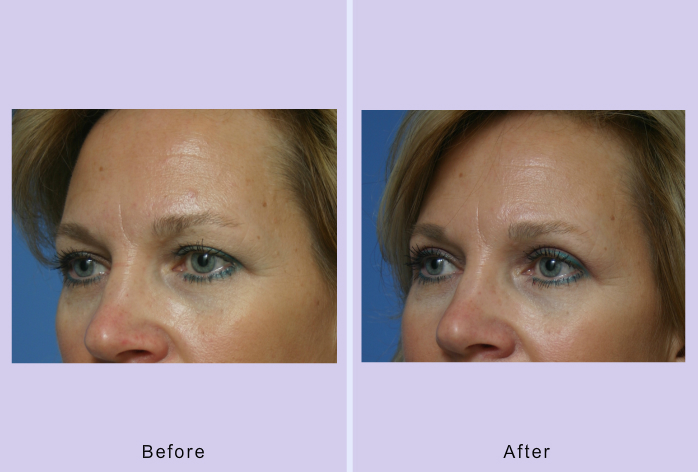 Before and After Image: Blepharoplasty – Case 17 - left-front-oblique