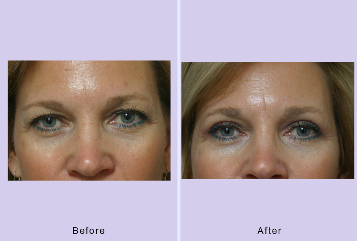 Before and After Image: Blepharoplasty – Case 17 - front