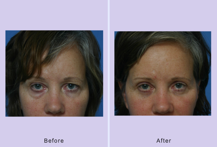 Before and After Image: blepharoplasty – case 14 - front