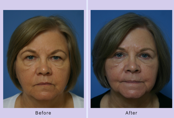 Before and After Image: Blepharoplasty – Case 18 - front