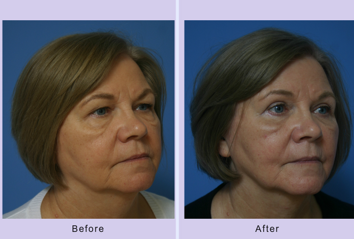 Before and After Image: Blepharoplasty – Case 18 - right-front-oblique