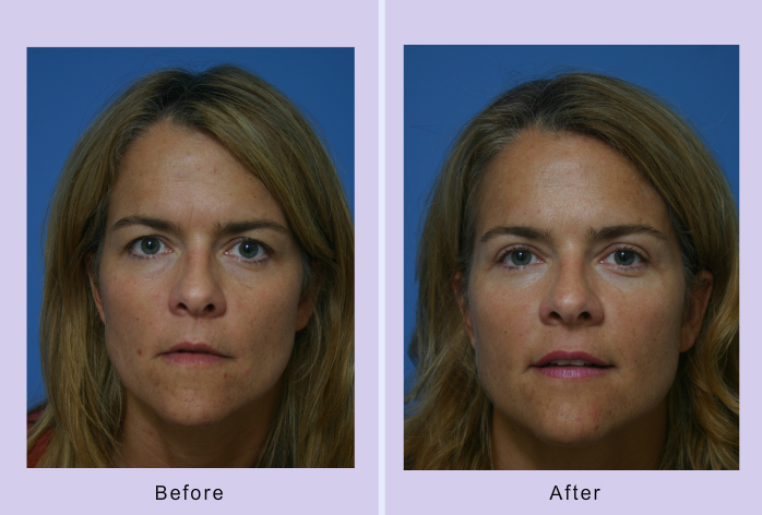 Before and After Image: Blepharoplasty – Case 19 - front