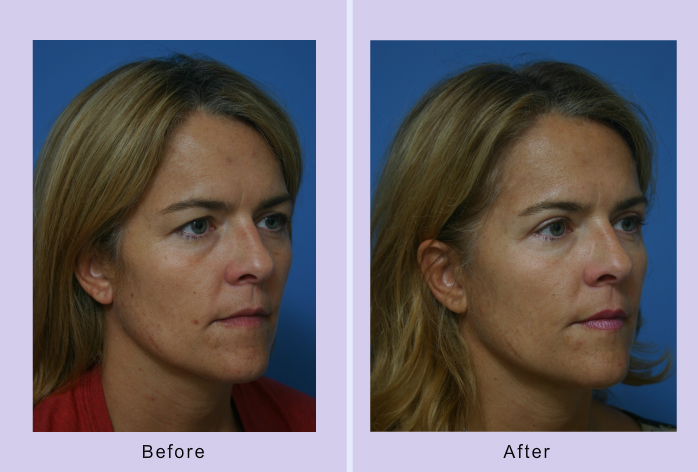 Before and After Image: Blepharoplasty – Case 19 - other