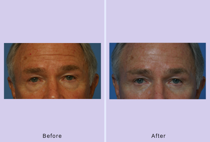 Before and After Image: Blepharoplasty – Case 20 - front