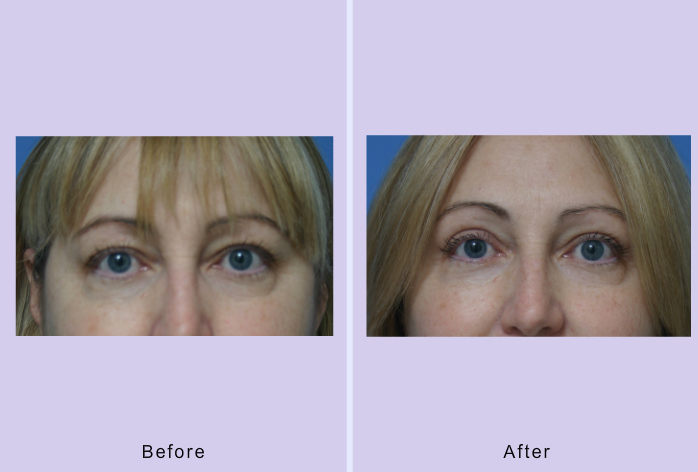 Before and After Image: blepharoplasty – case 21 - front