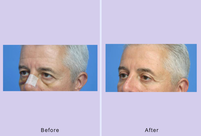 Before and After Image: blepharoplasty – case 22 - left-front-oblique