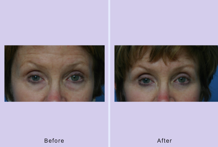 Before and After Image: blepharoplasty – case 23 - front