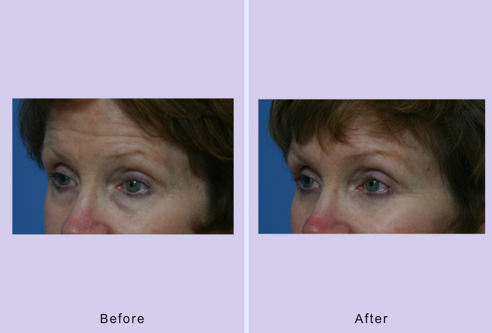 Before and After Image: blepharoplasty – case 23 - left-front-oblique