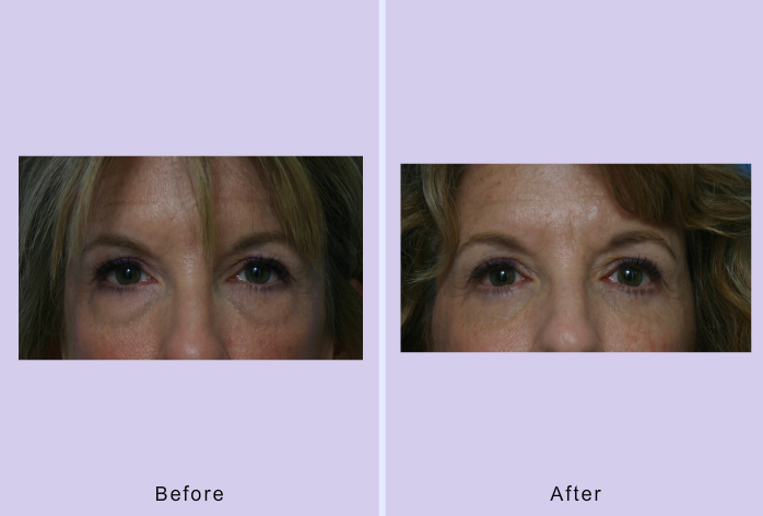 Before and After Image: blepharoplasty – case 24 - front