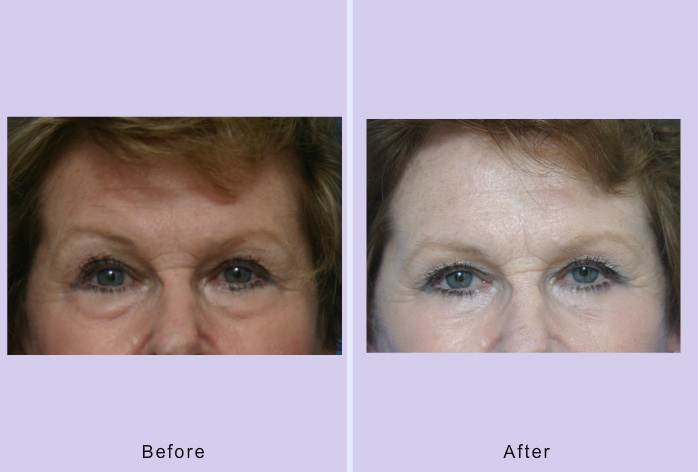 Before and After Image: blepharoplasty – case 25 - front