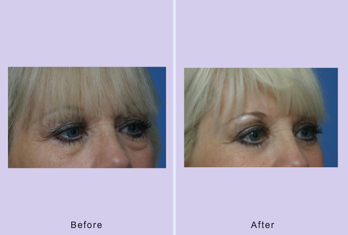 Before and After Image: blepharoplasty – case 26 - front