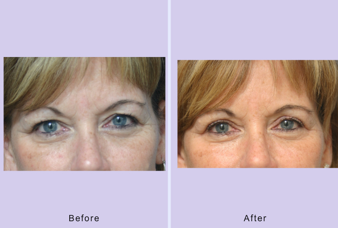 Before and After Image: blepharoplasty – case 27 - front