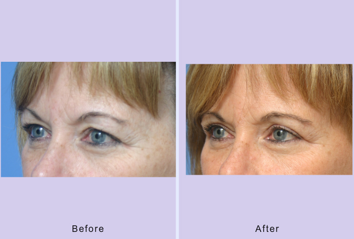 Before and After Image: blepharoplasty – case 27 - left-front-oblique