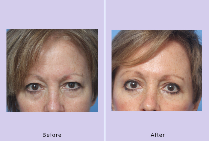 Before and After Image: blepharoplasty – case 28 - front