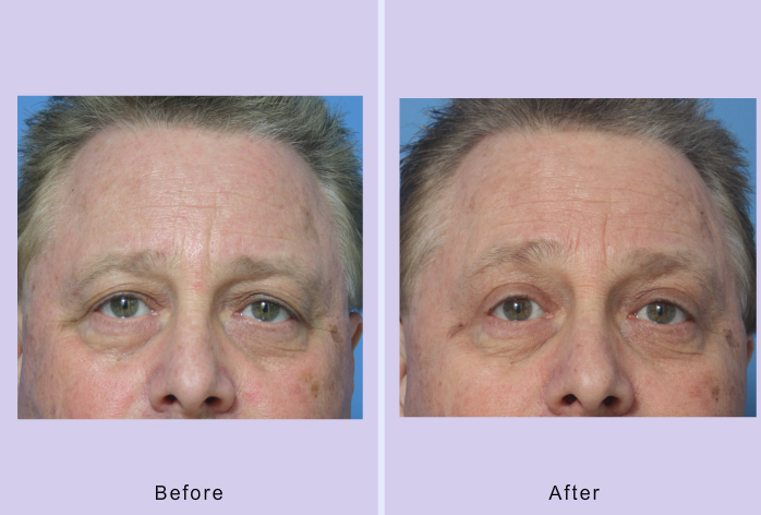 Before and After Image: blepharoplasty – case 29 - front
