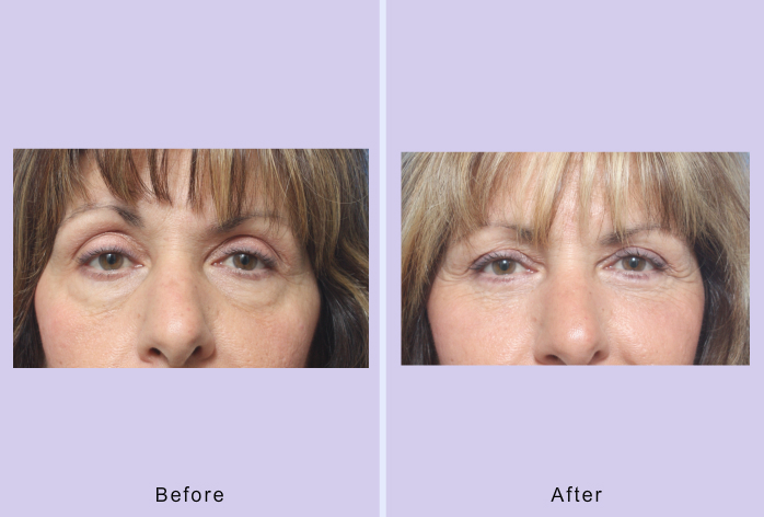 Before and After Image: blepharoplasty – case 30 - front
