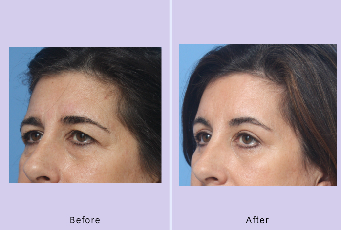 Before and After Image: blepharoplasty – case 31 - left-front-oblique
