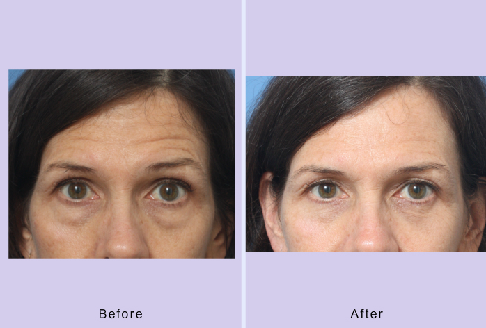 Before and After Image: Blepharoplasty – Case 32 - front