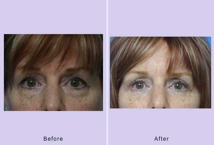 Before and After Image: lower blepharoplasty – case 33 - front