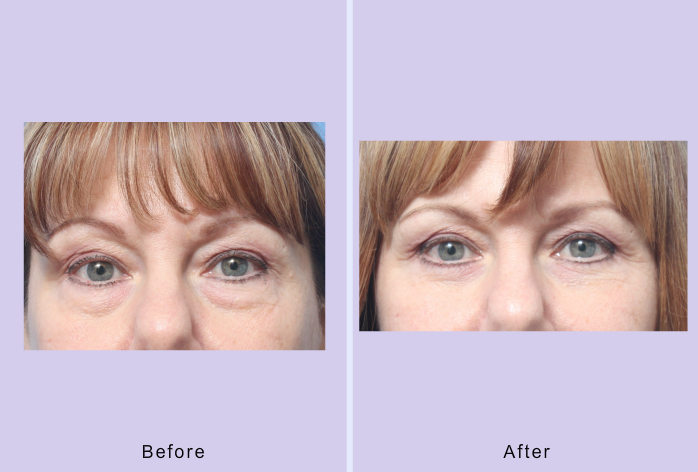 Before and After Image: lower blepharoplasty – case 34 - front