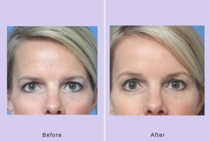 Before and After Image: browlift – case 5 - front
