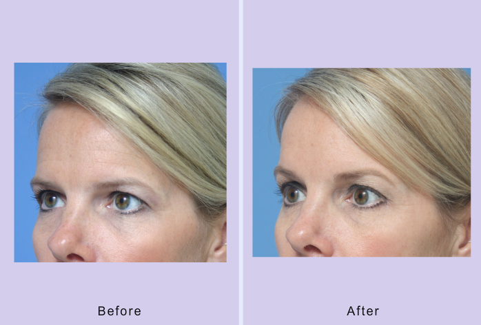 Before and After Image: browlift – case 5 - left-front-oblique