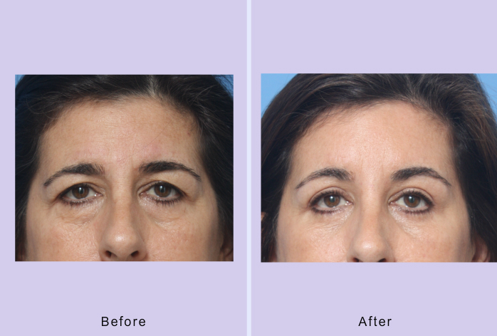 Before and After Image: browlift – case 6 - front