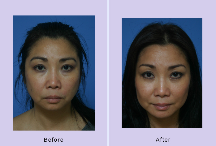 Before and After Image: Chin augmentation – Case 5 - front