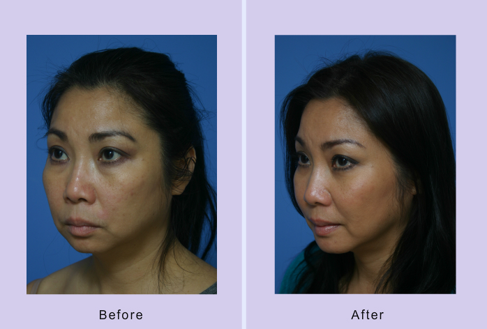 Before and After Image: Chin augmentation – Case 5 - left-front-oblique