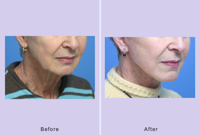 Before and After Image: facelift and mini facelift – case 1 - right-front-oblique