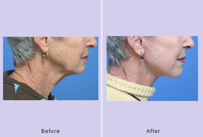 Before and After Image: facelift and mini facelift – case 1 - right-side