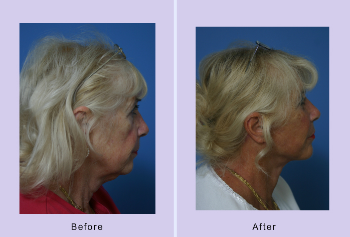Before and After Image: facelift and mini facelift – case 12 - right-side