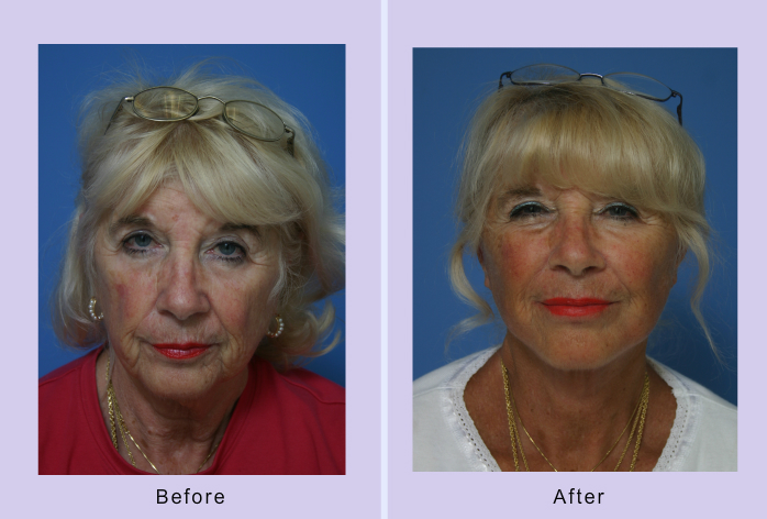 Before and After Image: facelift and mini facelift – case 12 - front